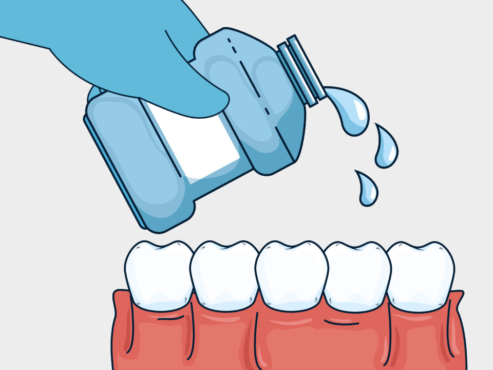 Jakie są korzyści płynące z regularnego stosowania płynu do płukania jamy ustnej z fluorem